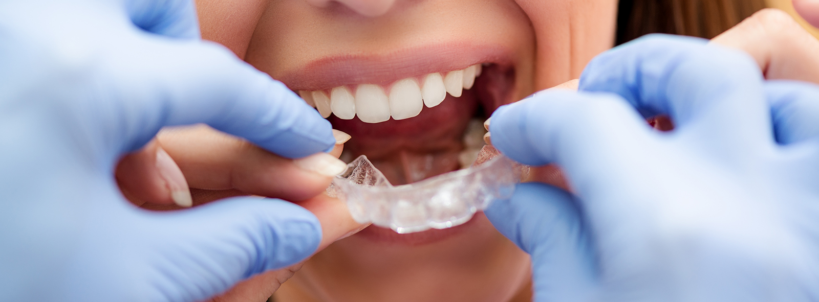 Invisalign Simi Valley